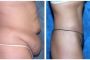 001-001-tummy