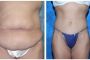 001-002-tummy