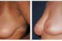 001-002-breast-lift