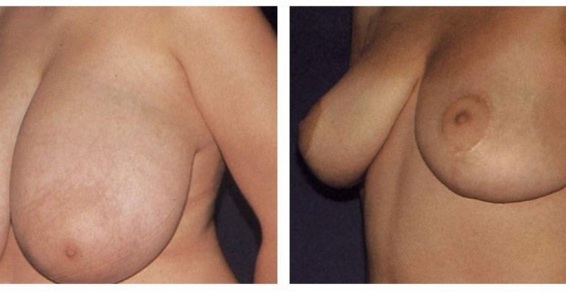 001-002-breast-red