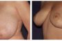 001-002-breast-red